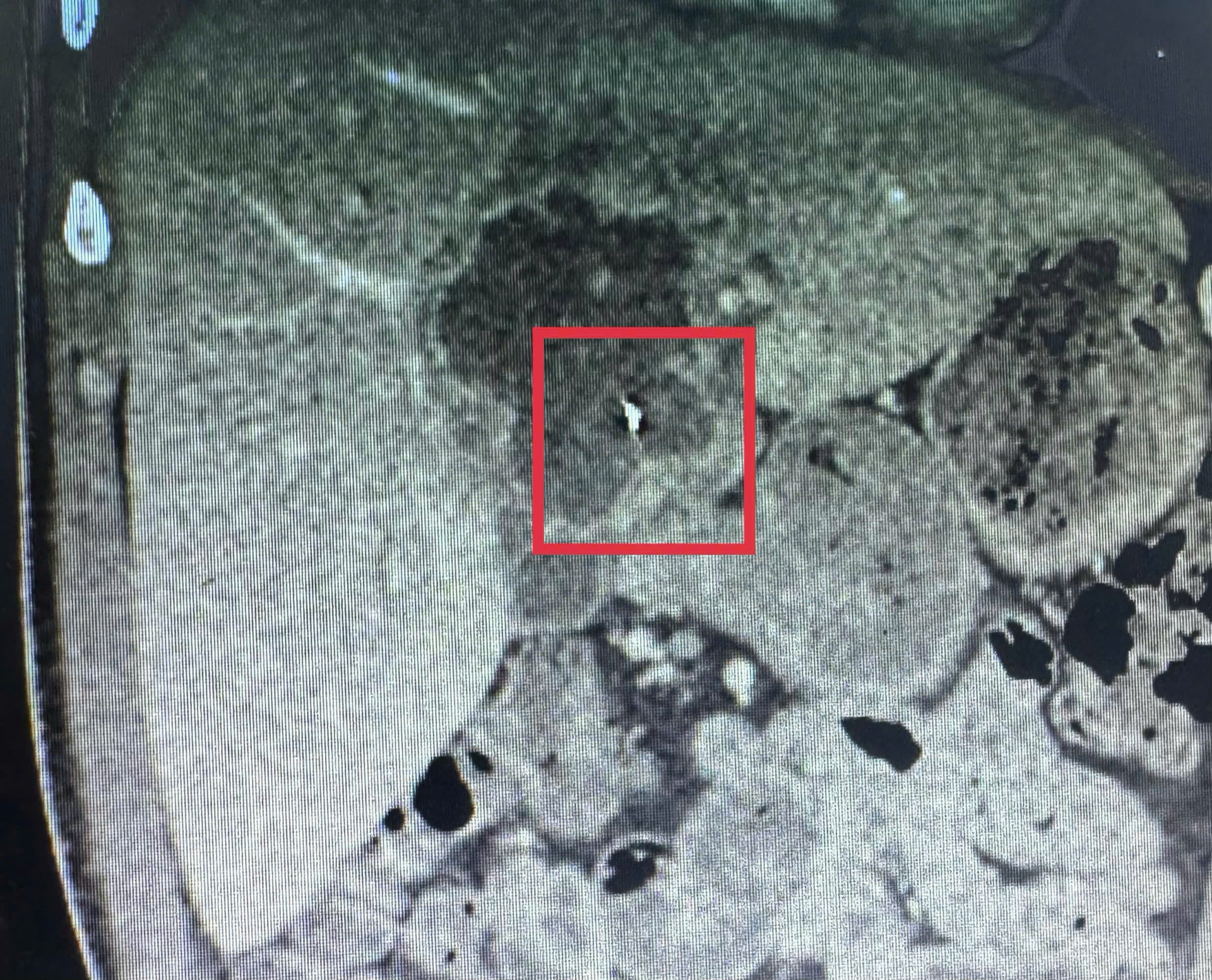 Phẫu thuật nội soi lấy dị vật kim loại trong gan – Ca bệnh hiếm gặp được xử trí thành công