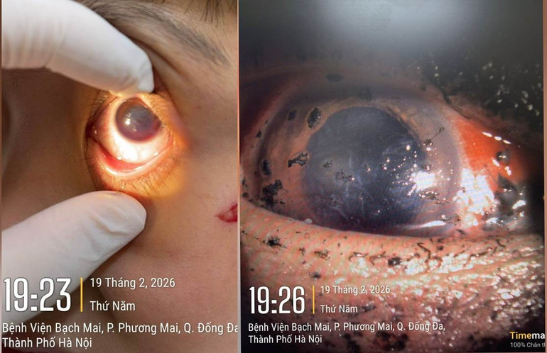 Chấn thương mắt nghiêm trọng do pháo nổ dịp Tết Nguyên đán Chấn thương mắt nghiêm trọng do pháo nổ dịp Tết Nguyên đán