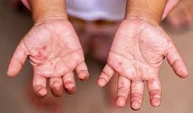 TP Hồ Chí Minh ghi nhận 3 ca tử vong do mắc tay chân miệng