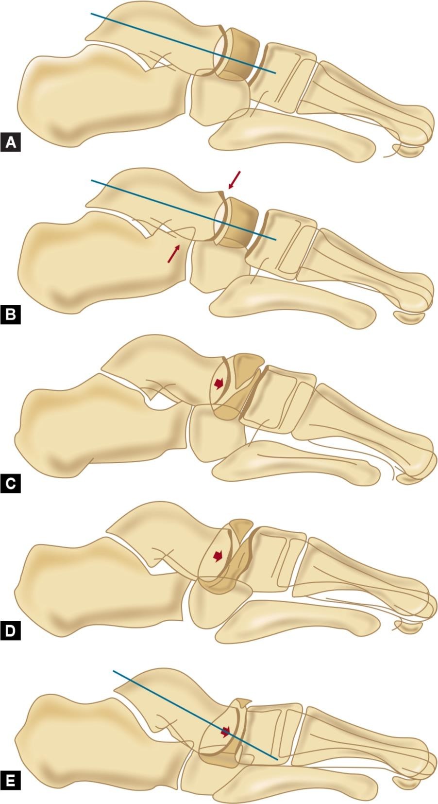 Đau khớp cổ chân khởi phát không rõ nguyên nhân, đi khám phát hiện Hội chứng Müller-Weiss hiếm gặp Đau khớp cổ chân khởi phát không rõ nguyên nhân, đi khám phát hiện Hội chứng Müller-Weiss hiếm gặp
