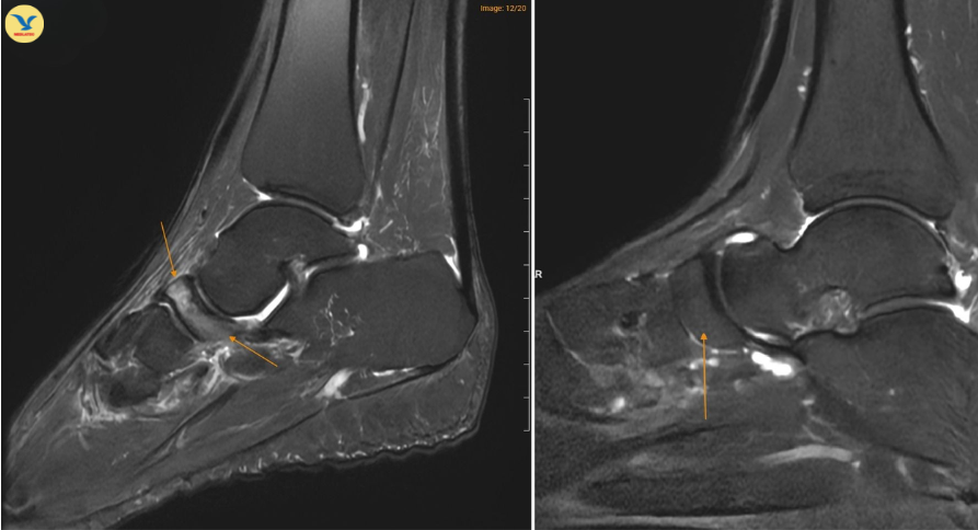 Đau khớp cổ chân khởi phát không rõ nguyên nhân, đi khám phát hiện Hội chứng Müller-Weiss hiếm gặp Đau khớp cổ chân khởi phát không rõ nguyên nhân, đi khám phát hiện Hội chứng Müller-Weiss hiếm gặp