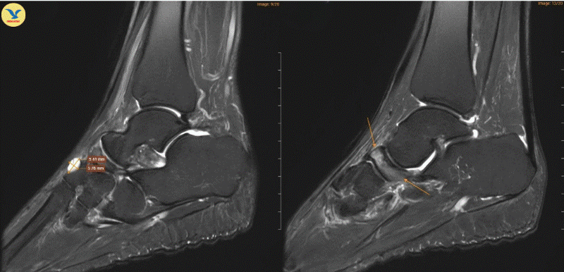 Đau khớp cổ chân khởi phát không rõ nguyên nhân, đi khám phát hiện Hội chứng Müller-Weiss hiếm gặp