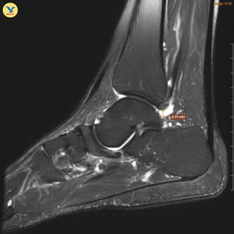 Đau khớp cổ chân khởi phát không rõ nguyên nhân, đi khám phát hiện Hội chứng Müller-Weiss hiếm gặp Đau khớp cổ chân khởi phát không rõ nguyên nhân, đi khám phát hiện Hội chứng Müller-Weiss hiếm gặp