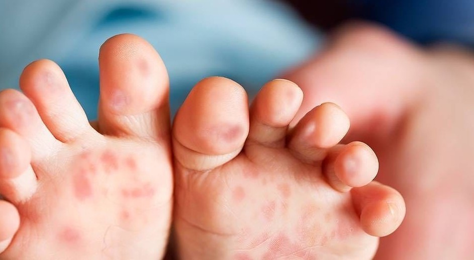 Số ca tay chân miệng tăng mạnh: Bộ Y tế yêu cầu tăng cường kiểm soát và phòng bệnh