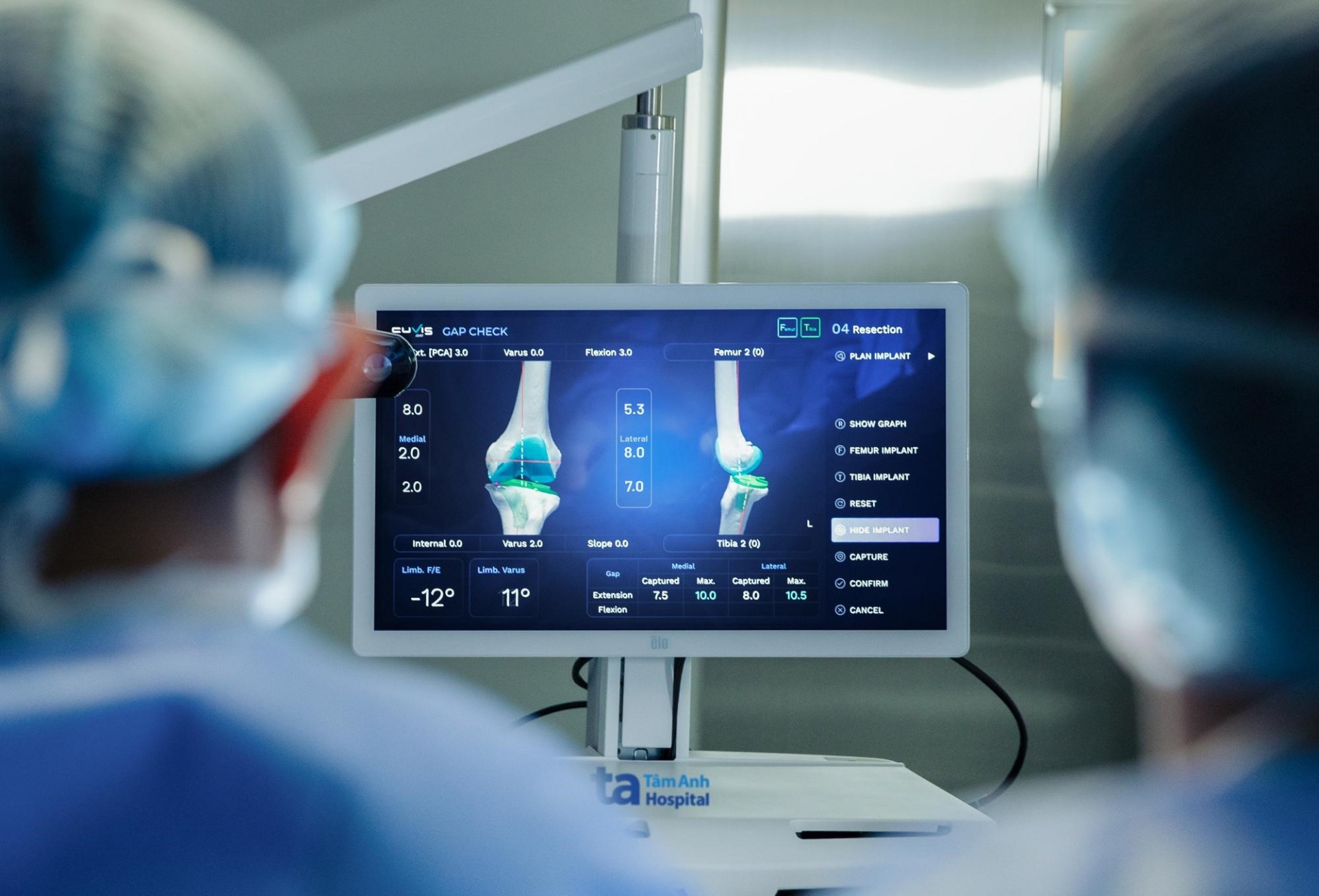 Lần đầu tiên Việt Nam có Robot AI thay khớp cắt xương chuẩn xác từng milimet Lần đầu tiên Việt Nam có Robot AI thay khớp cắt xương chuẩn xác từng milimet