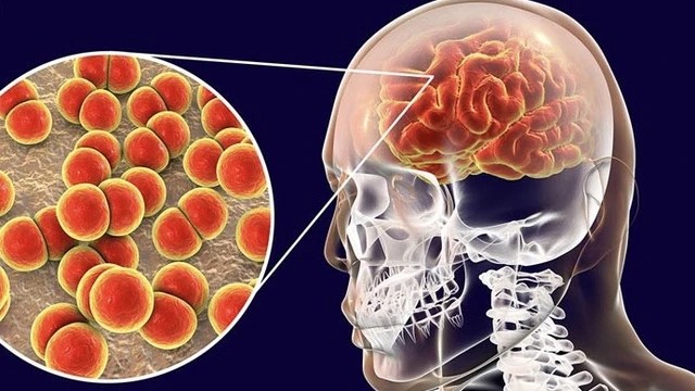 Ca bệnh do não mô cầu gia tăng