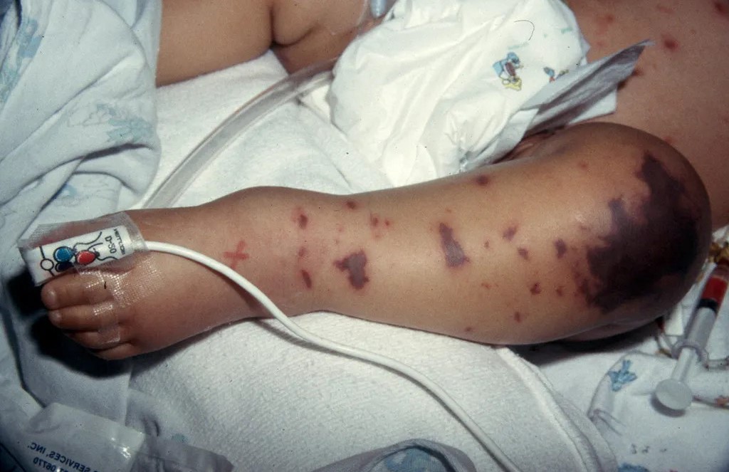 Ca bệnh do não mô cầu gia tăng Ca bệnh do não mô cầu gia tăng