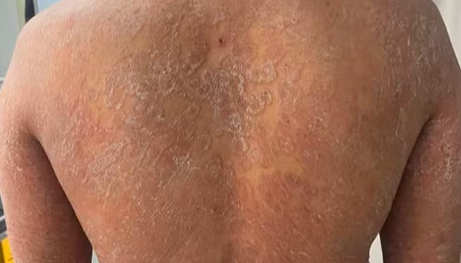 Sai lầm trong điều trị nấm da, bệnh da bùng phát khắp cơ thể