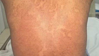 Sai lầm trong điều trị nấm da, bệnh da bùng phát khắp cơ thể