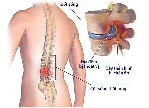 Thoát vị đĩa đệm: “kẻ giấu mặt” đẩy người bệnh đến nguy cơ tàn phế