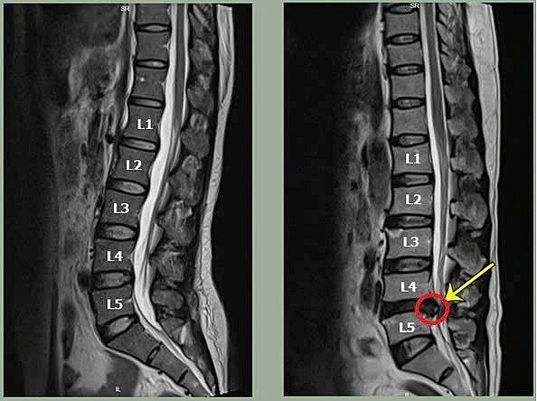 Thoát vị đĩa đệm: “kẻ giấu mặt” đẩy người bệnh đến nguy cơ tàn phế