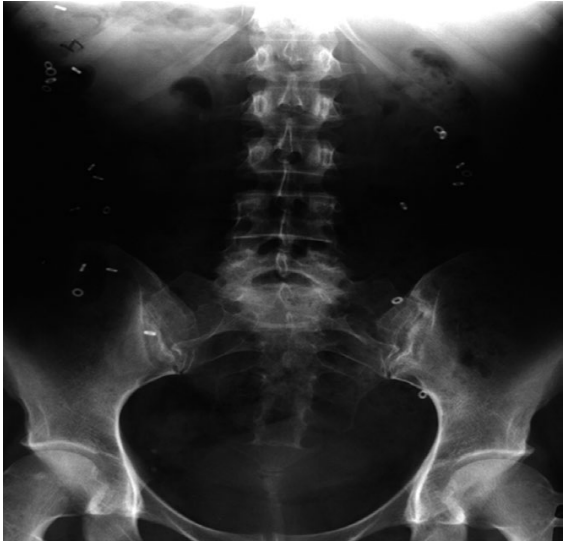 Tiếp cận chẩn đoán bệnh nhân táo bón mạn tính do đờ đại tràng