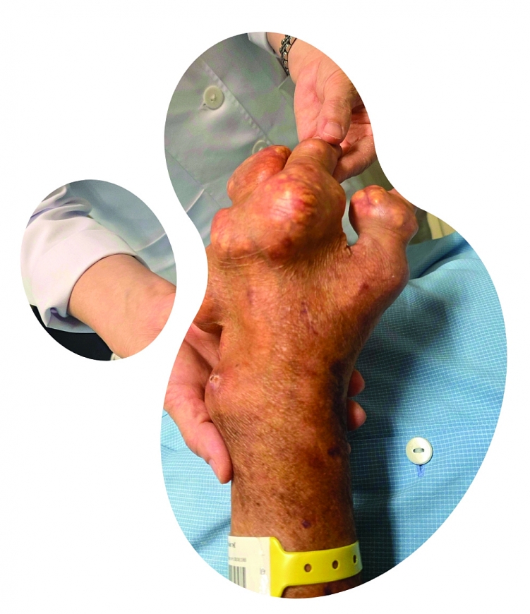 Gút - Đừng để “cơn đau trong đêm” trở thành nỗi ám ảnh suốt đời