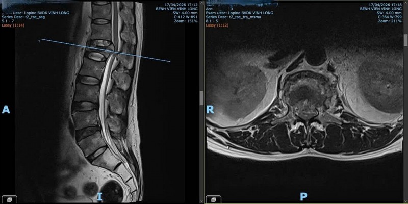Bệnh viện Đa khoa Vĩnh Long phẫu thuật cấp cứu thành công trường hợp hội chứng chùm đuôi ngựa do chấn thương cột sống ngã từ giàn giáo