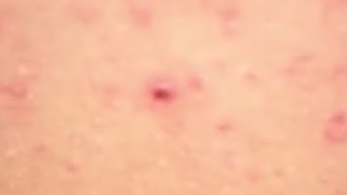Ba người tử vong do virus Hanta, Bộ Y tế khuyến cáo 5 biện pháp phòng bệnh