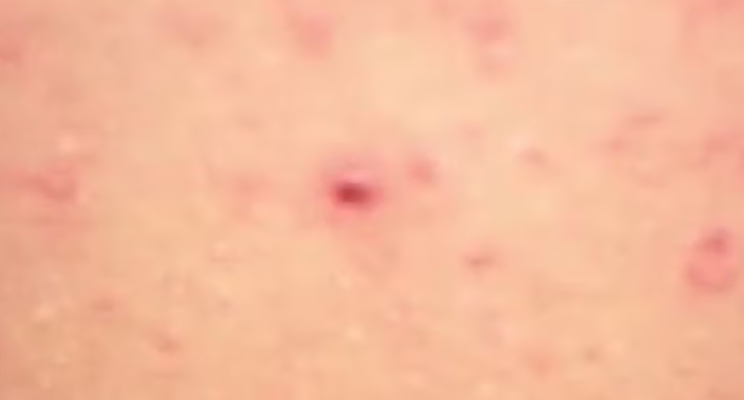 Ba người tử vong do virus Hanta, Bộ Y tế khuyến cáo 5 biện pháp phòng bệnh