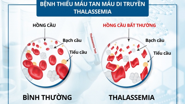 Bệnh tan máu bẩm sinh: Bệnh di truyền lặn nhưng phổ biến nhất ở Việt Nam và thế giới