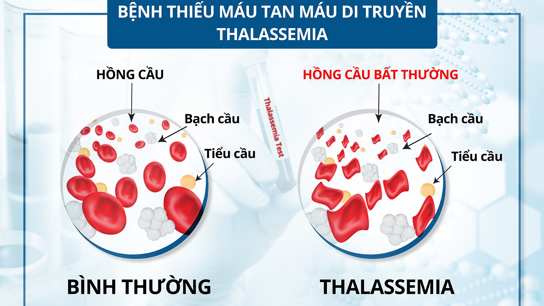 Bệnh tan máu bẩm sinh: Bệnh di truyền lặn nhưng phổ biến nhất ở Việt Nam và thế giới
