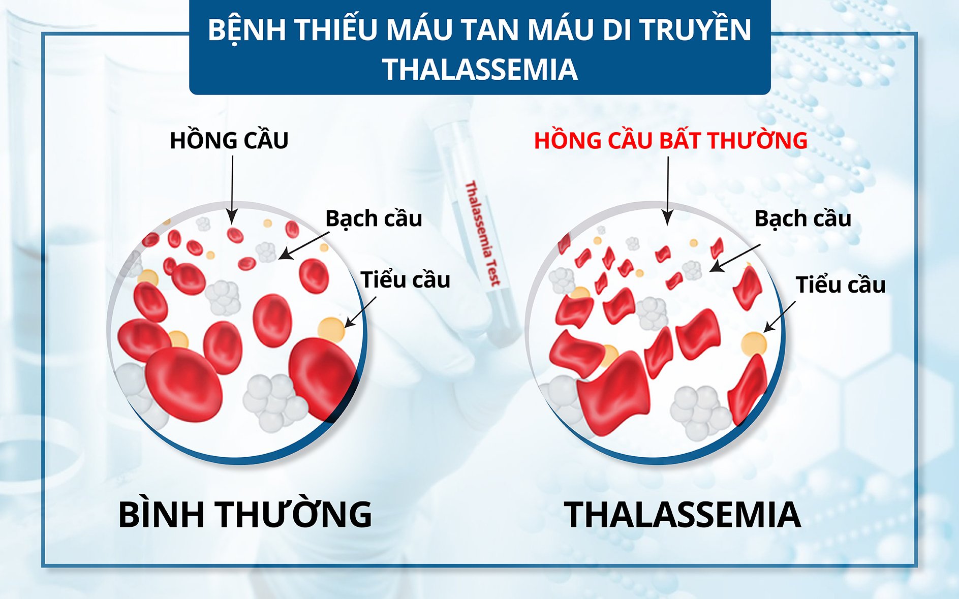 Bệnh tan máu bẩm sinh: Bệnh di truyền lặn nhưng phổ biến nhất ở Việt Nam và thế giới