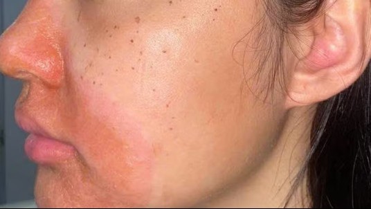 Cảnh báo biến chứng viêm da tiếp xúc nặng sau peel da tại spa