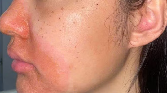 Cảnh báo biến chứng viêm da tiếp xúc nặng sau peel da tại spa