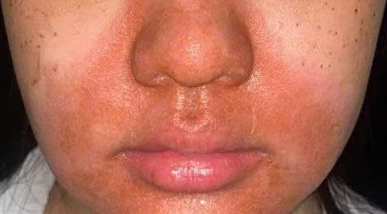 Cảnh báo biến chứng viêm da tiếp xúc nặng sau peel da tại spa