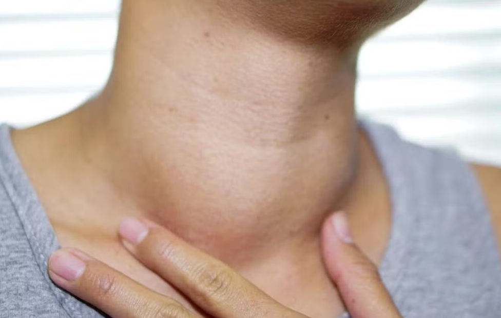 Nguyên nhân bướu cổ: Không chỉ do thiếu i-ốt như nhiều người vẫn nghĩ Nguyên nhân bướu cổ: Không chỉ do thiếu i-ốt như nhiều người vẫn nghĩ