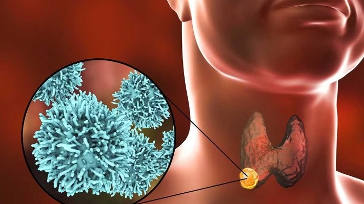 Nguyên nhân bướu cổ: Không chỉ do thiếu i-ốt như nhiều người vẫn nghĩ
