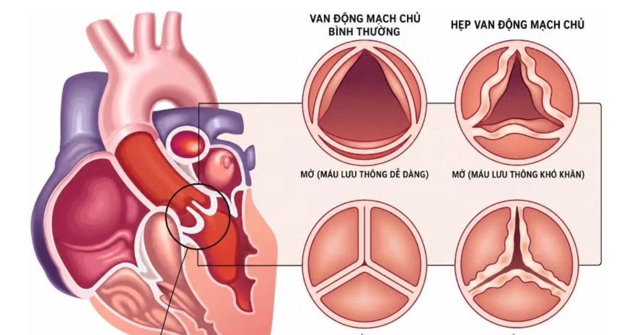Cuộc “cách mạng” trong điều trị hẹp van động mạch chủ