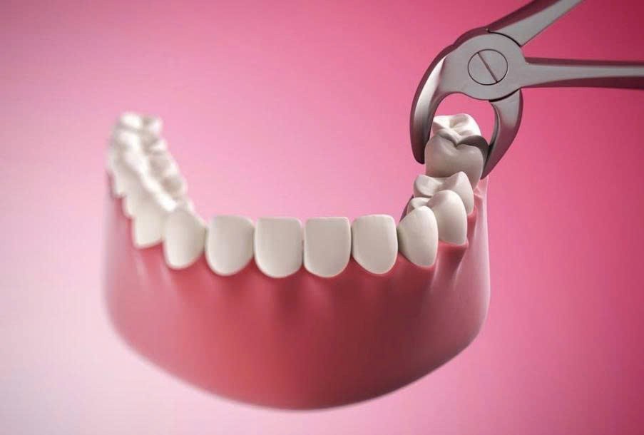 Nhổ răng khôn trước khi niềng Invisalign: có thực sự cần thiết?