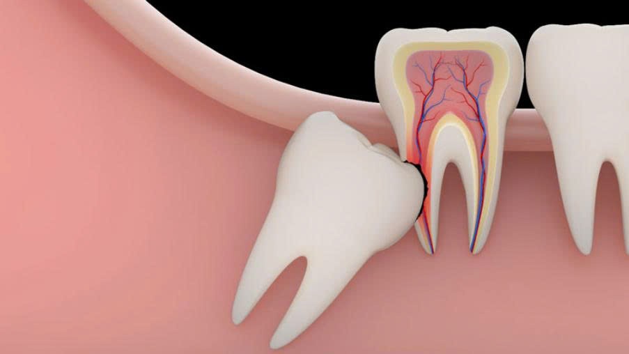Nhổ răng khôn trước khi niềng Invisalign: có thực sự cần thiết?