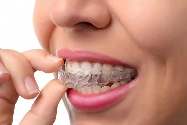 Nhổ răng khôn trước khi niềng Invisalign: có thực sự cần thiết?