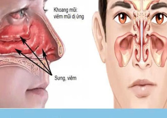 Nghẹt mũi mùa hè: Cảnh giác nhầm lẫn giữa dị ứng và viêm xoang