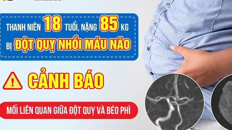 Đột quỵ không còn là bệnh của người già