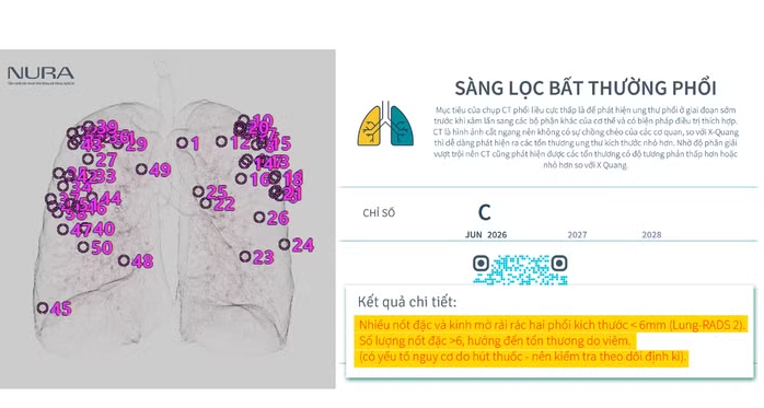 CT liều thấp kết hợp AI: Hướng tiếp cận mới trong tầm soát ung thư sớm CT liều thấp kết hợp AI: Hướng tiếp cận mới trong tầm soát ung thư sớm