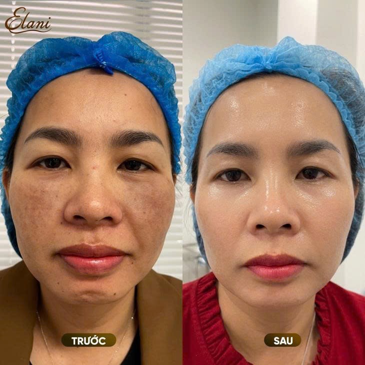 Cá nhân hóa phác đồ điều trị giúp nâng cao hiệu quả cải thiện làn da và đường nét khuôn mặt tại phòng khám da liễu ELANI Cá nhân hóa phác đồ điều trị giúp nâng cao hiệu quả cải thiện làn da và đường nét khuôn mặt tại phòng khám da liễu ELANI