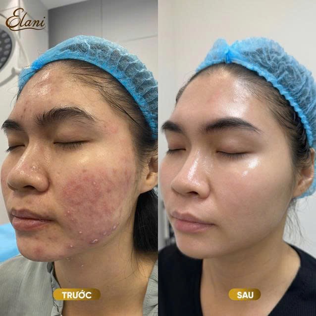 Cá nhân hóa phác đồ điều trị giúp nâng cao hiệu quả cải thiện làn da và đường nét khuôn mặt tại phòng khám da liễu ELANI Cá nhân hóa phác đồ điều trị giúp nâng cao hiệu quả cải thiện làn da và đường nét khuôn mặt tại phòng khám da liễu ELANI