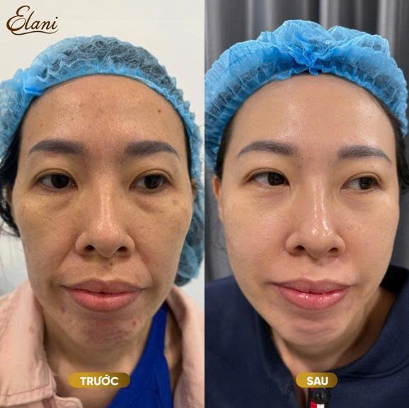 Cá nhân hóa phác đồ điều trị giúp nâng cao hiệu quả cải thiện làn da và đường nét khuôn mặt tại phòng khám da liễu ELANI Cá nhân hóa phác đồ điều trị giúp nâng cao hiệu quả cải thiện làn da và đường nét khuôn mặt tại phòng khám da liễu ELANI