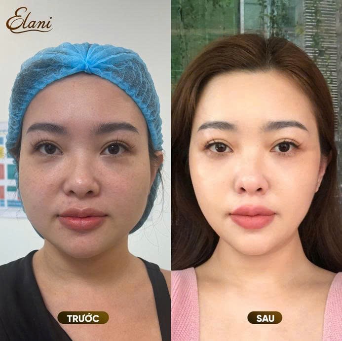 Cá nhân hóa phác đồ điều trị giúp nâng cao hiệu quả cải thiện làn da và đường nét khuôn mặt tại phòng khám da liễu ELANI Cá nhân hóa phác đồ điều trị giúp nâng cao hiệu quả cải thiện làn da và đường nét khuôn mặt tại phòng khám da liễu ELANI