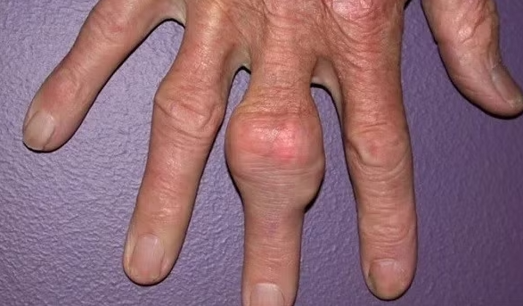 Gút không chỉ gây đau khớp: Những biến chứng ít người ngờ tới