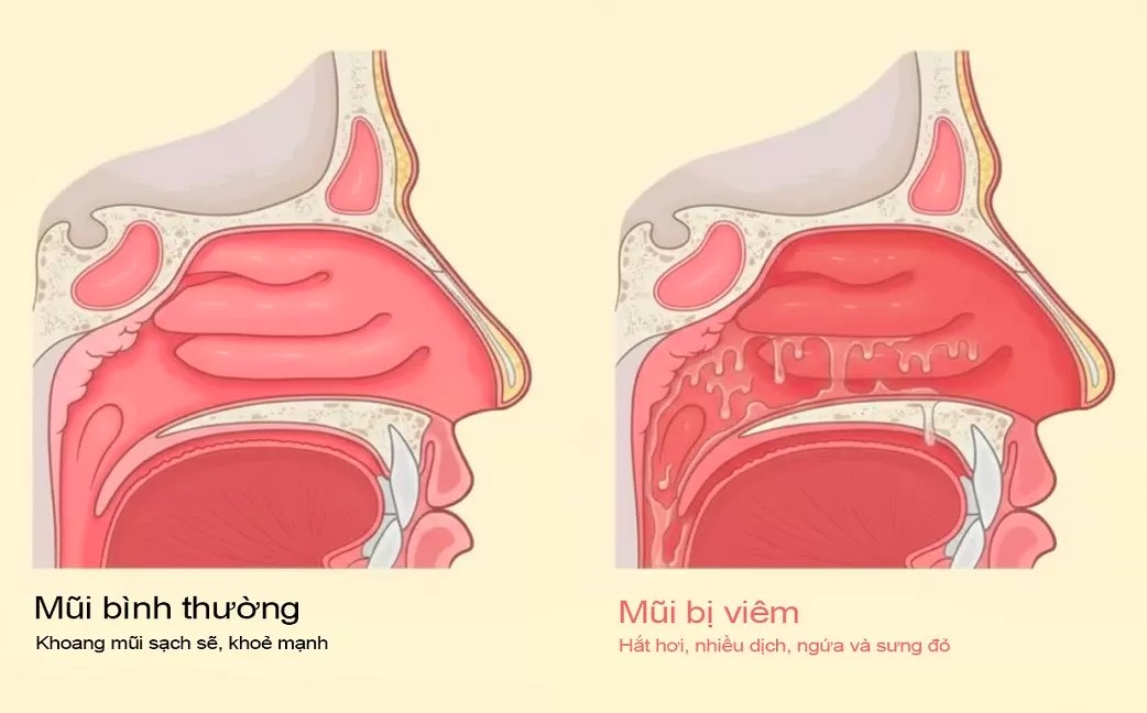 Chẩn đoán bệnh y học cổ truyền, kết hợp y học cổ truyền với y học hiện đại: VIÊM MŨI DO VẬN MẠCH VÀ DỊ ỨNG (TỲ CỪU, TỲ UYÊN)