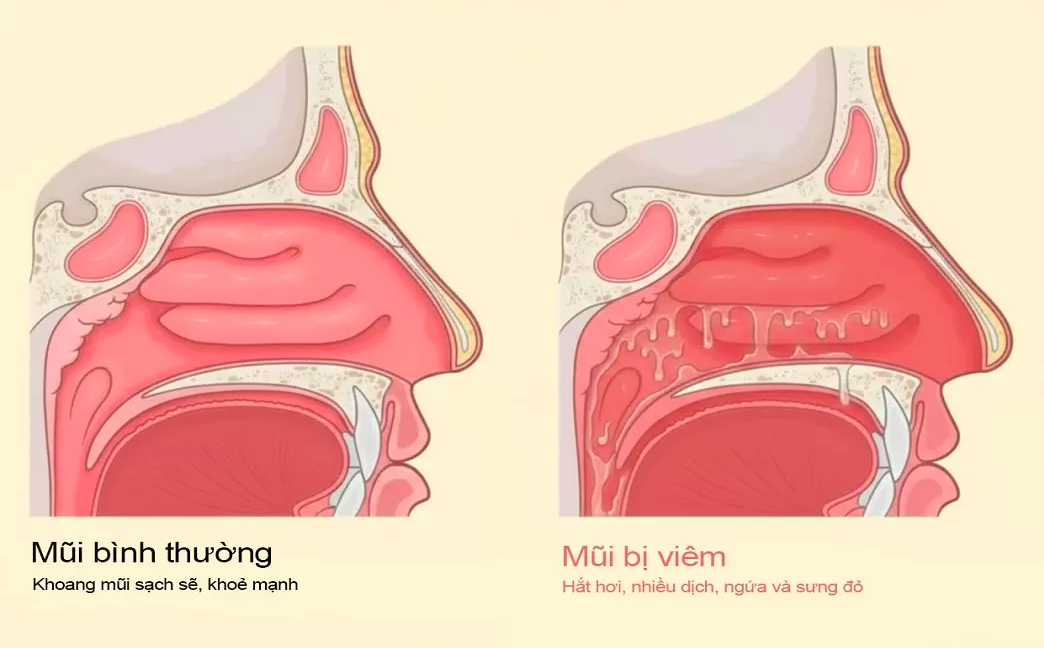 VIÊM MŨI DO VẬN MẠCH VÀ DỊ ỨNG (TỲ CỪU, TỲ UYÊN) VIÊM MŨI DO VẬN MẠCH VÀ DỊ ỨNG (TỲ CỪU, TỲ UYÊN)