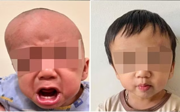 Bước tiến trong điều trị dị tật sọ mặt: Mỗi ngày kéo giãn xương 1mm thay thế đại phẫu Bước tiến trong điều trị dị tật sọ mặt: Mỗi ngày kéo giãn xương 1mm thay thế đại phẫu