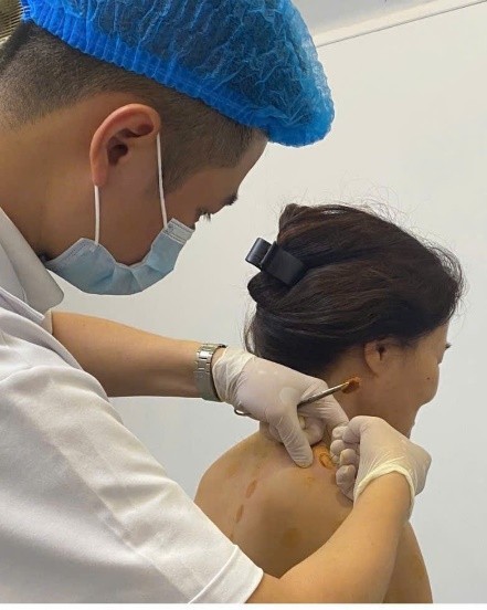 Cấy Chỉ Trong Phục Hồi Chức Năng Sau Đột Quỵ: Cơ chế tính dẻo thần kinh (Neuroplasticity) và kinh nghiệm lâm sàng từ mô hình điều trị tích hợp. Cấy Chỉ Trong Phục Hồi Chức Năng Sau Đột Quỵ: Cơ chế tính dẻo thần kinh (Neuroplasticity) và kinh nghiệm lâm sàng từ mô hình điều trị tích hợp.