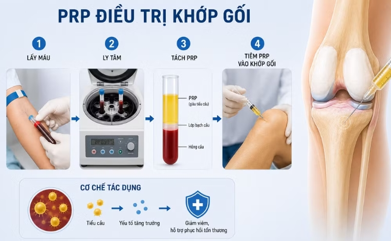 Điều trị thoái hóa khớp gối bằng huyết tương giàu tiểu cầu là gì? Điều trị thoái hóa khớp gối bằng huyết tương giàu tiểu cầu là gì?