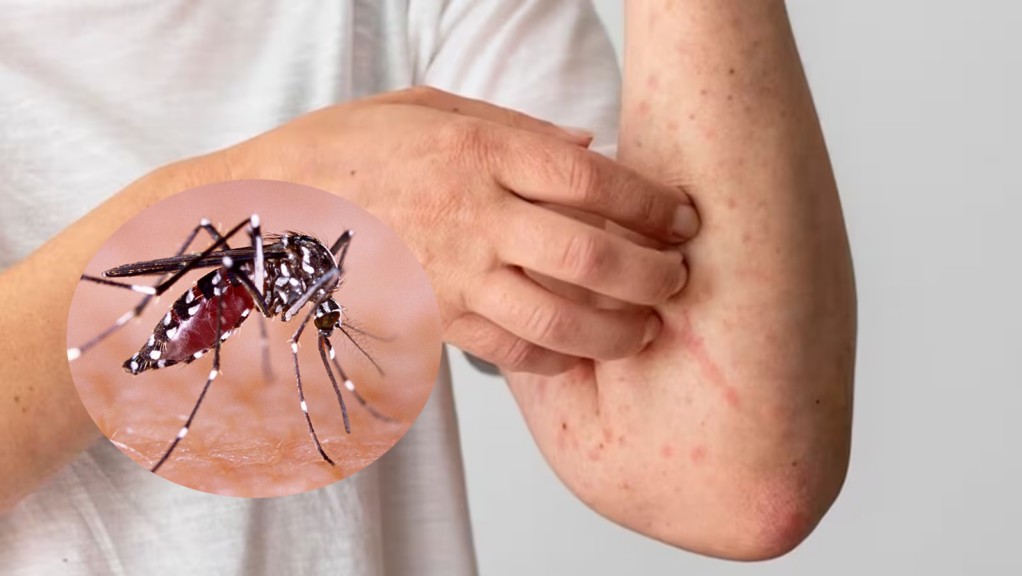 Bài 3: Sốt xuất huyết Dengue (ôn bệnh)