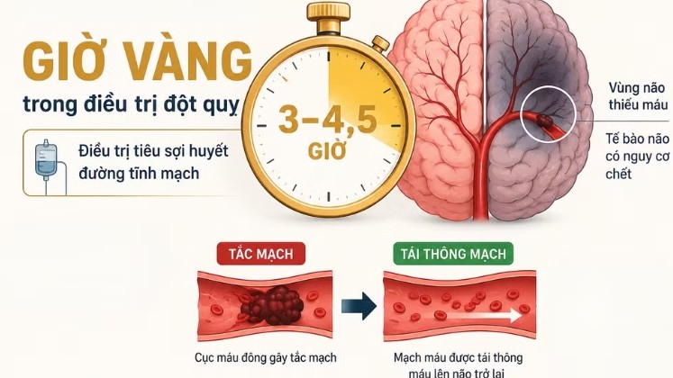 "Giờ vàng" đột quỵ: Ranh giới của hồi phục và tàn phế