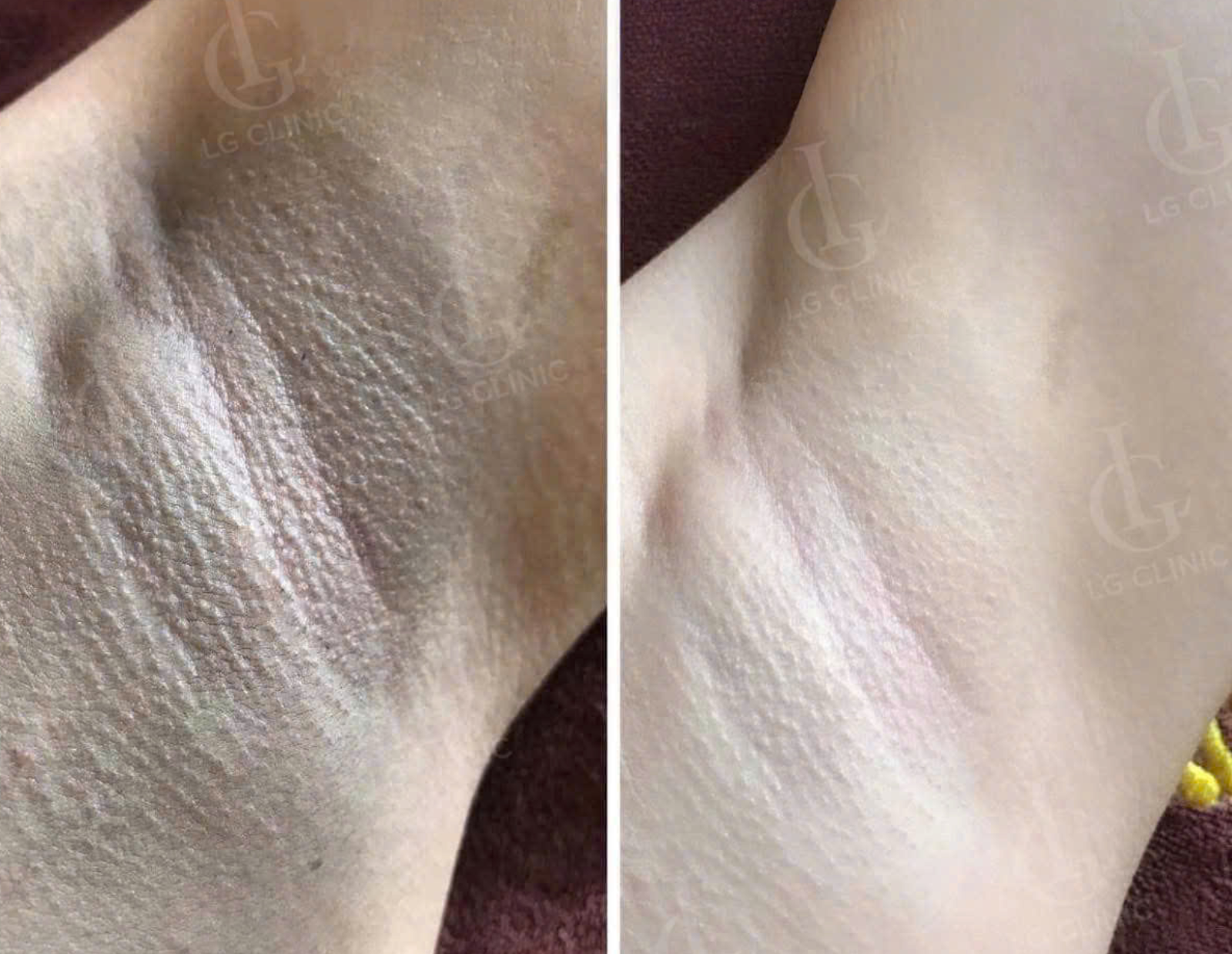 Tổng hợp những cách trị thâm body nách, bẹn, mông cực hiệu quả Tổng hợp những cách trị thâm body nách, bẹn, mông cực hiệu quả