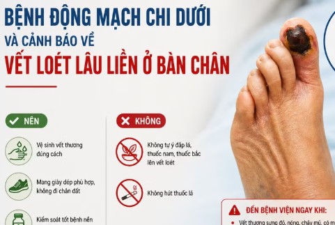 Vết loét lâu liền ở bàn chân có thể là dấu hiệu thiếu máu chi