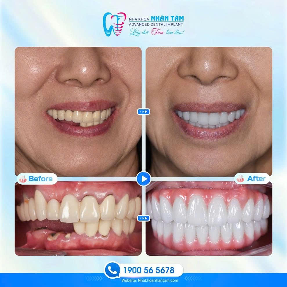 Quy trình trồng răng Implant chuẩn y khoa Quy trình trồng răng Implant chuẩn y khoa